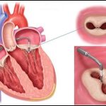 افتادگی دریچه میترال