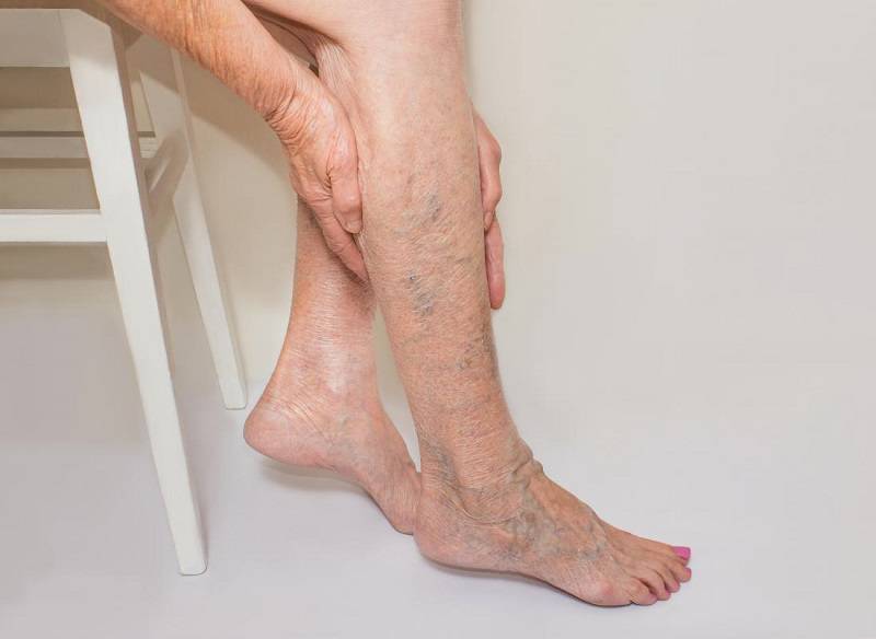 واریس اگزما و علائم آن