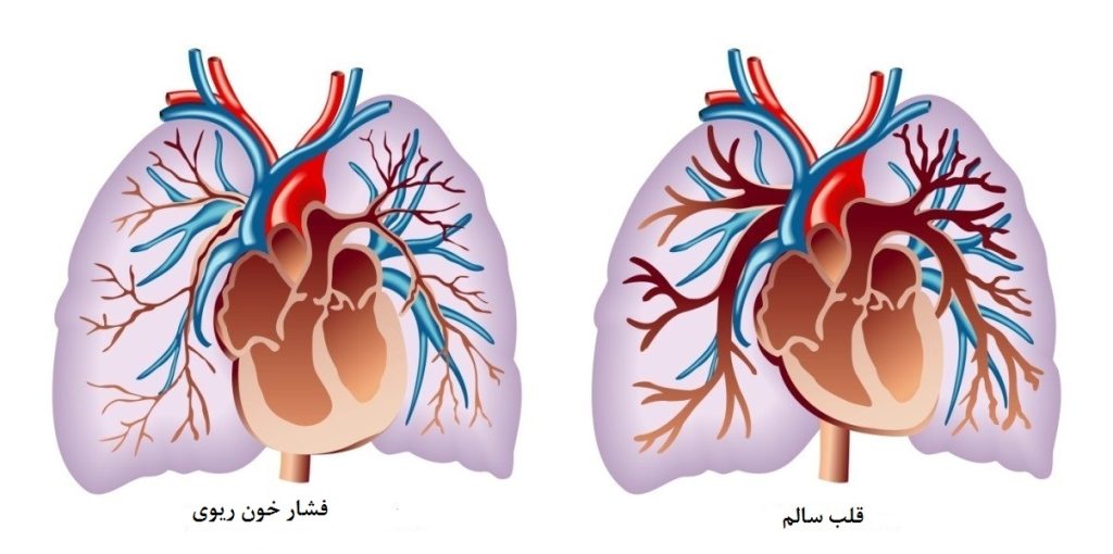فشار خون بالای ریه ها