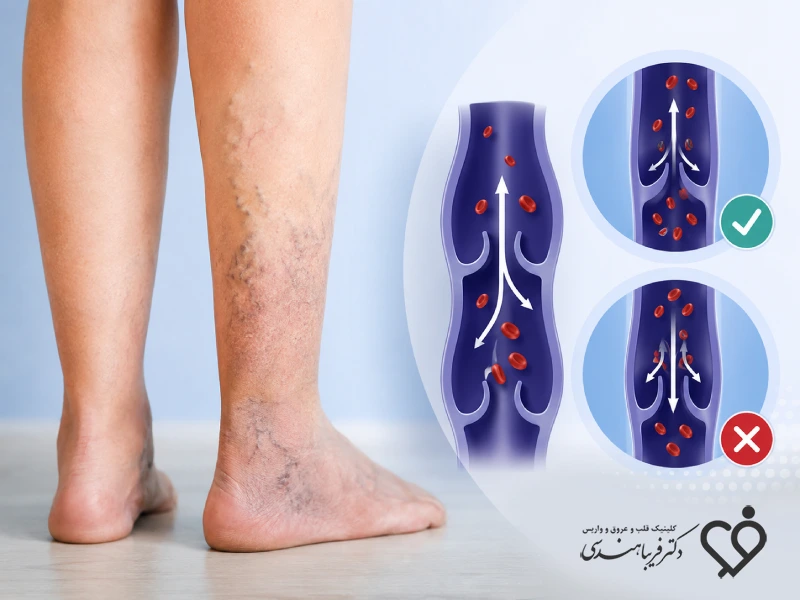 نارسایی مزمن وریدی
