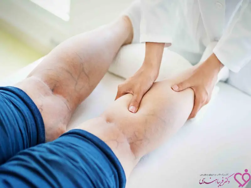 تشخیص واریس پا