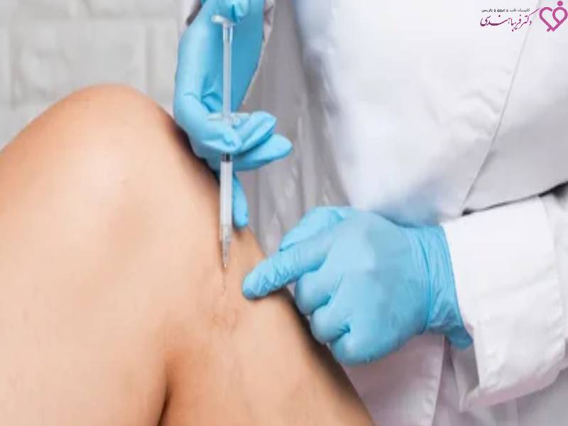اسکلروتراپی برای درمان واریس