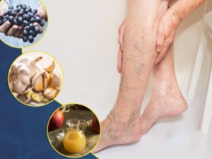 تغذیه برای درمان واریس