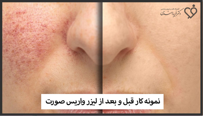 نمونه قبل و بعد لیزر واریس صورت