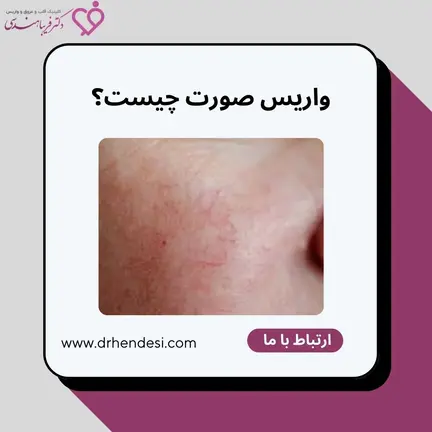واریس صورت
