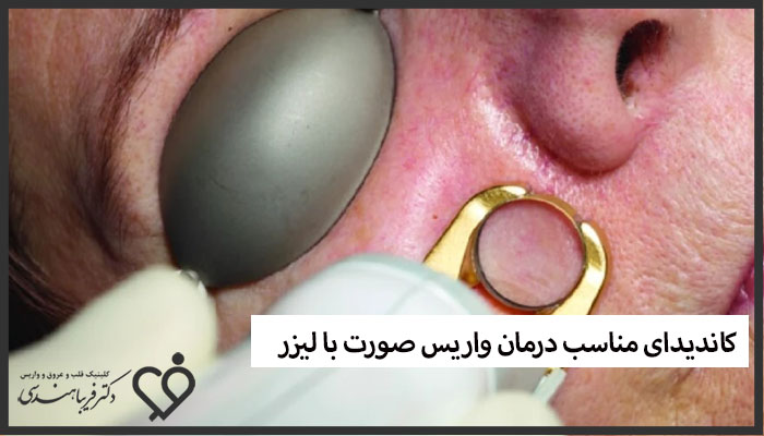 کاندیدای مناسب درمان واریس صورت با لیزر
