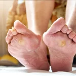 آنژیوگرافی پای دیابتی - دکتر فریبا هندسی