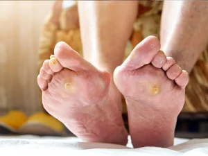 آنژیوگرافی پای دیابتی - دکتر فریبا هندسی