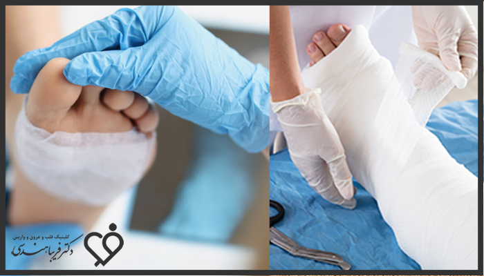 عوارض احتمالی بعد آنژیوگرافی پای دیابتی

