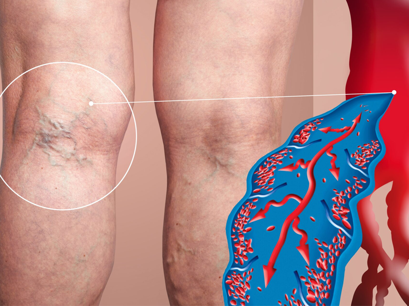 ترومبوز ورید عمقی (DVT) - لخته خون - دکتر فریبا هندسی