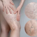 تفاوت واریس سطحی و عمقی (DVT) - دکتر فریبا هندسی