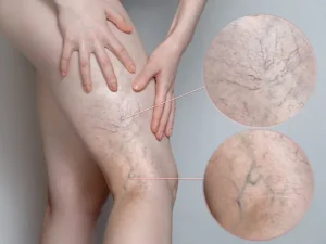 تفاوت واریس سطحی و عمقی (DVT) - دکتر فریبا هندسی