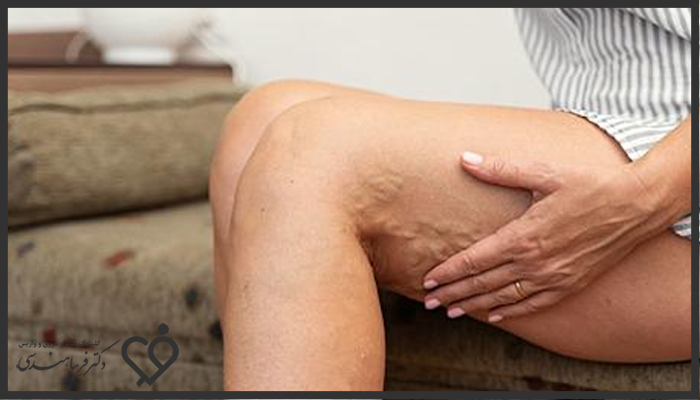 علائم مشخص واریس عمقی چیست؟