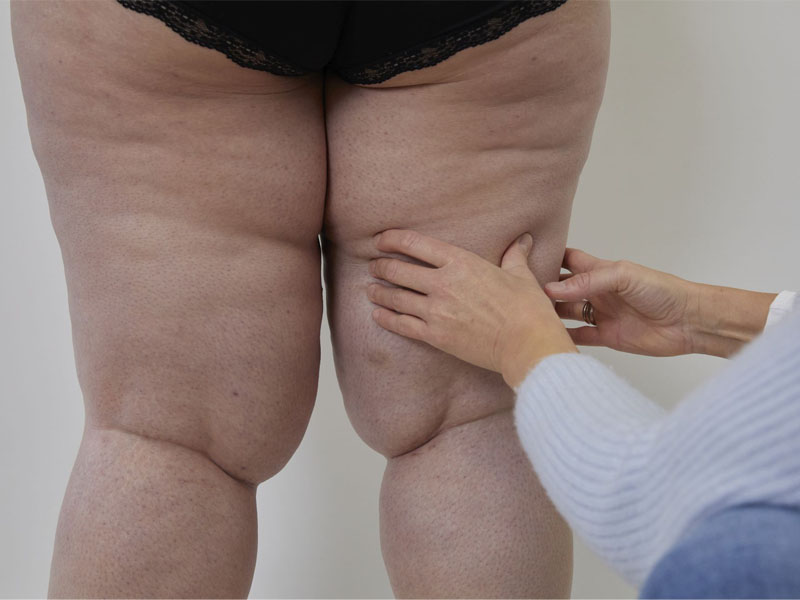 بیماری لیپیدما lipedeme - دکتر فریبا هندسی