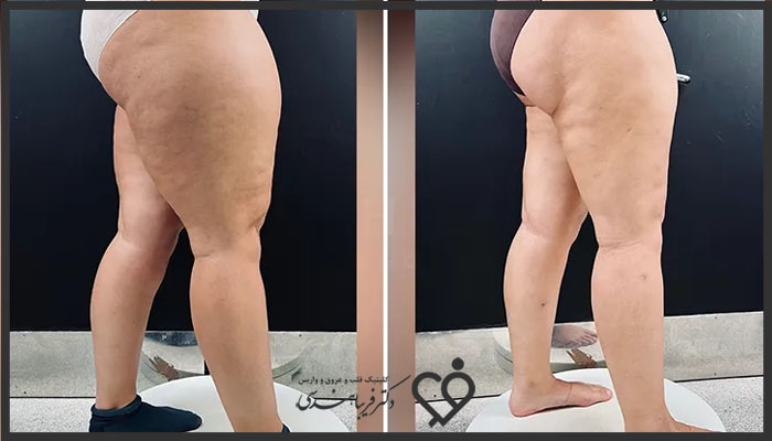 منظور از لیپیدما (lipedema) چیست؟ 