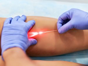 درمان واریس با لیزر - دکتر فریبا هندسی