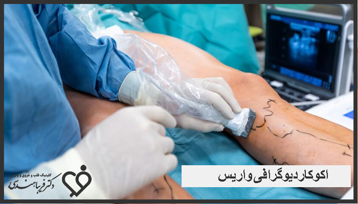 اکوکاردیوگرافی واریس