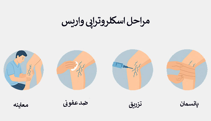 مراحل اسکلروتراپی واریس