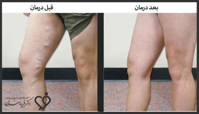 نمونه کار اسکلروتراپی - دکتر فریبا هندسی