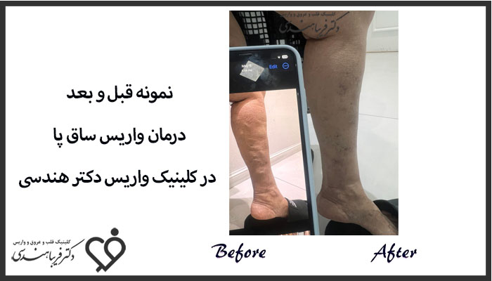 نمونه کار درمان واریس دکتر فریبا هندسی