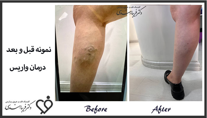 نمونه کار درمان واریس 3 - فریبا هندسی