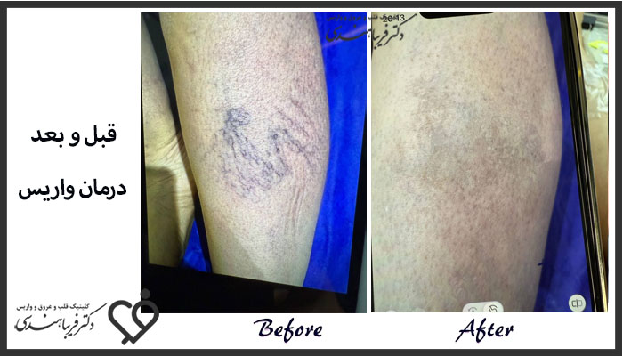 نمونه کار درمان واریس 4 - کلینیک دکتر فریبا هندسی