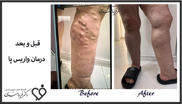 نمونه کار قبل و بعد درمان واریس دکتر فریبا هندسی