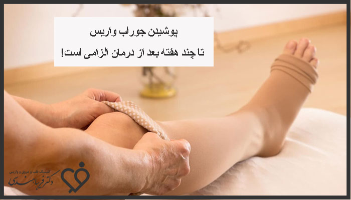 پوشیدن جوراب واریس بعد درمان واریس