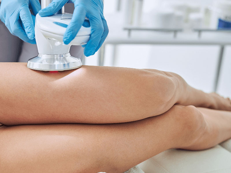 درمان سلولیت با لیزر - دکتر فریبا هندسی