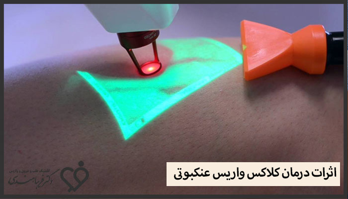 اثرات درمان کلاکس واریس عنکبوتی