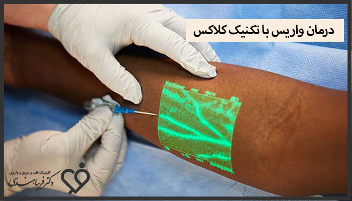 درمان واریس با تکنیک کلاکس