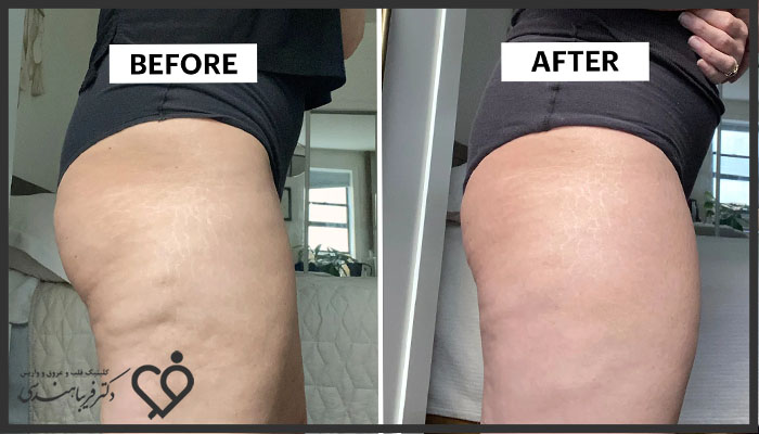 عکس قبل و بعد لیزر سلولیت