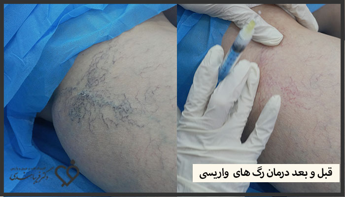 قبل و بعد درمان واریس  توسط دکتر فریبا هندسی