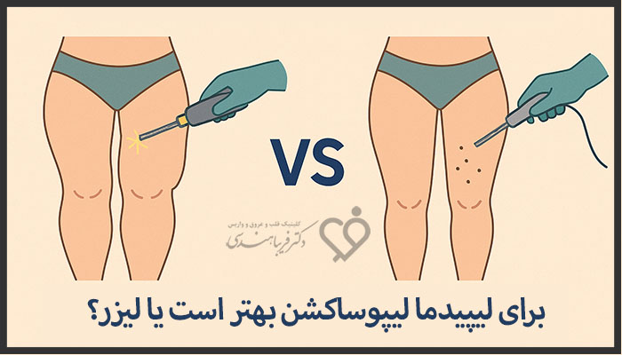 لیپوساکشن بهتر است یا لیزر در لیپیدما؟