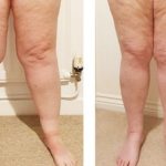 لیزر در مقابل لیپوساکشن در درمان لیپیدما - دکتر فریبا هندسی