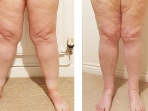 لیزر در مقابل لیپوساکشن در درمان لیپیدما - دکتر فریبا هندسی