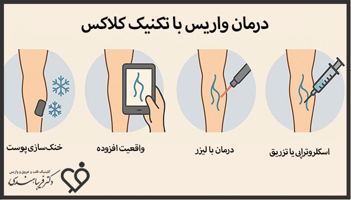 مراحل درمان واریس با کلاکس