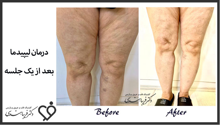 نمونه کار درمان لیپیدما کلینیک دکتر فریبا هندسی