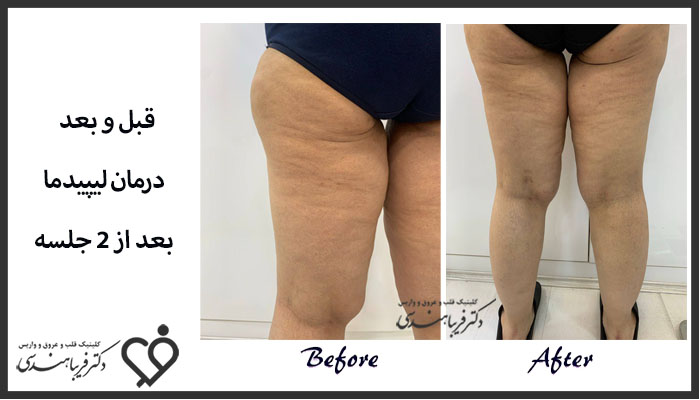 نمونه کار درمان لیپیدما در کلینیک دکتر هندسی
