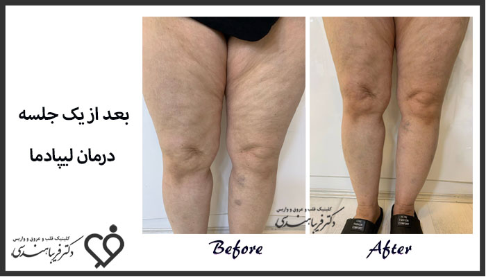 نمونه کار درمان لیپیدما دکتر هندسی