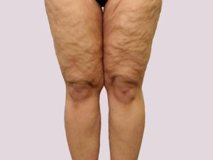 طول درمان لیپیدما و آنچه در دوران نقاهت باید بدانید! - دکتر فریبا هندسی