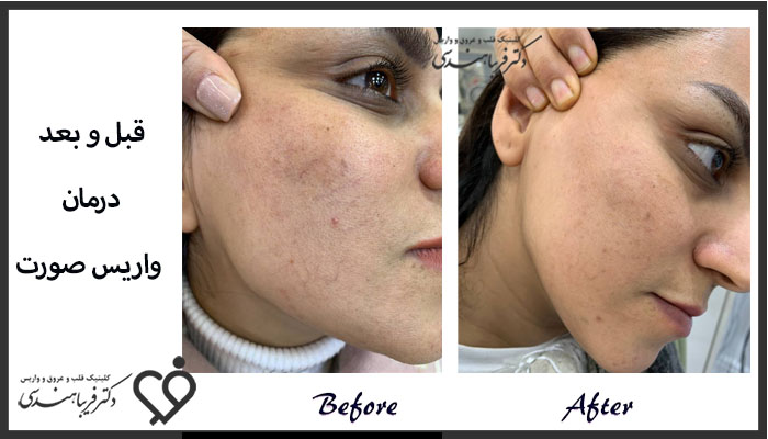 نمونه کار درمان واریس صورت دکتر فریبا هندسی