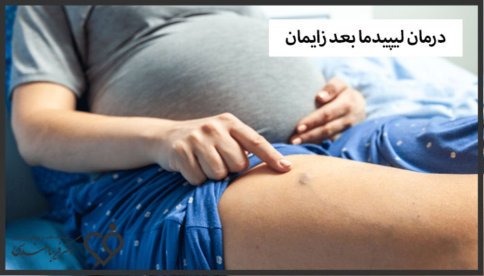 درمان لیپیدما بعد زایمان