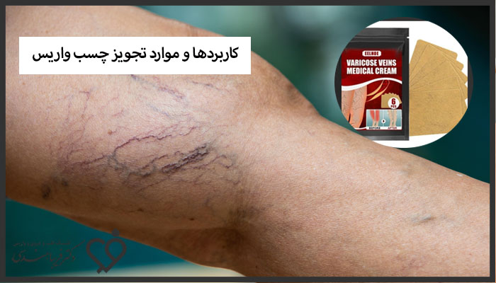 کاربردها و موارد تجویز چسب واریس