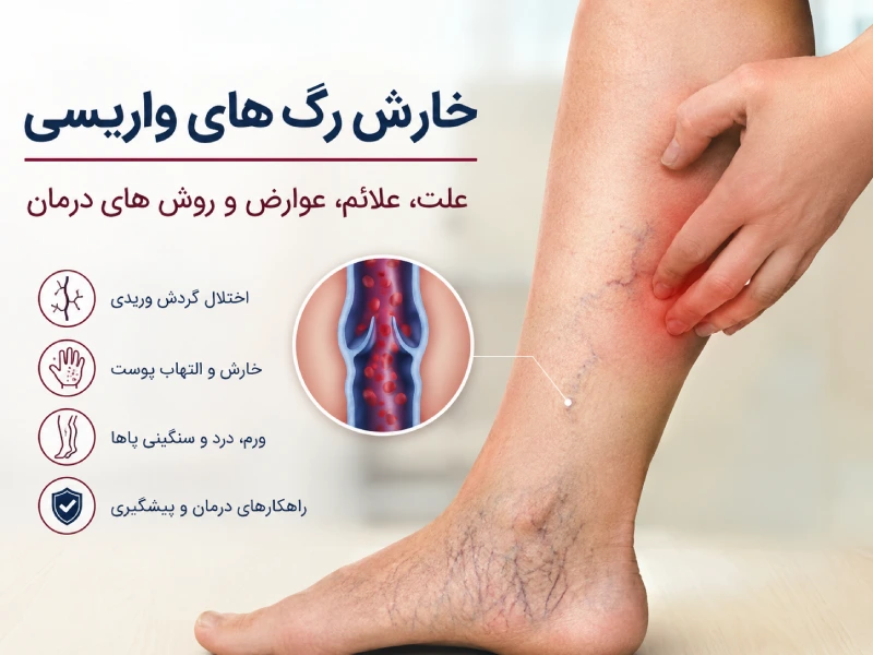 خارش رگ های واریسی