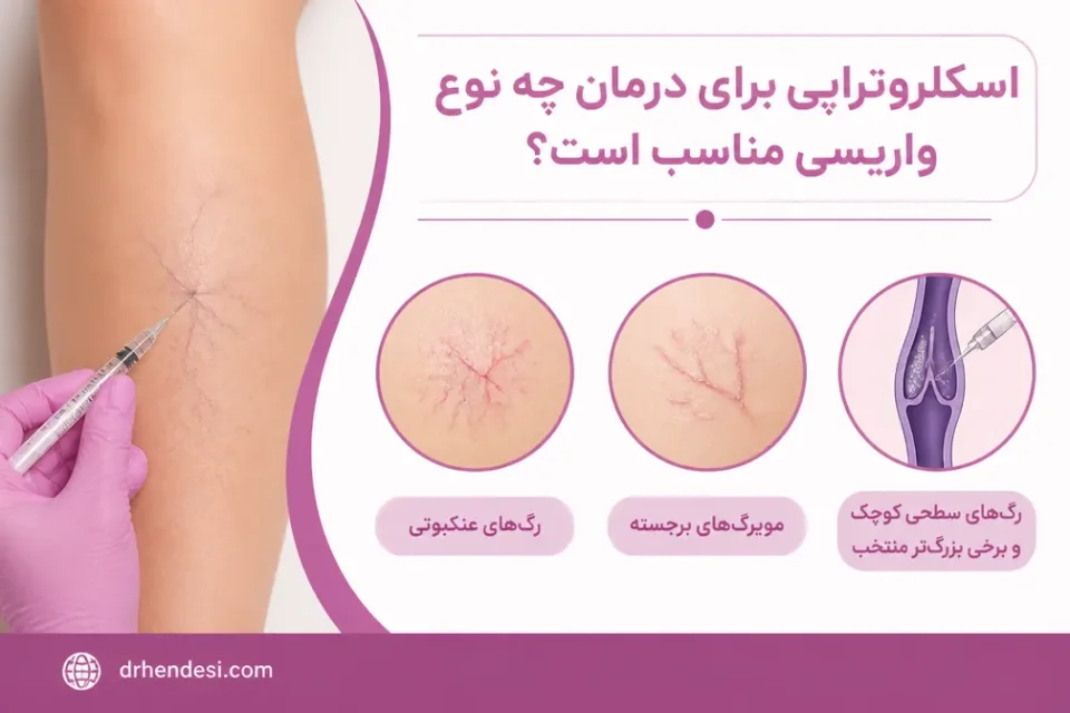 نمای توضیحی درباره اسکلروتراپی برای درمان چه نوع واریسی مناسب است