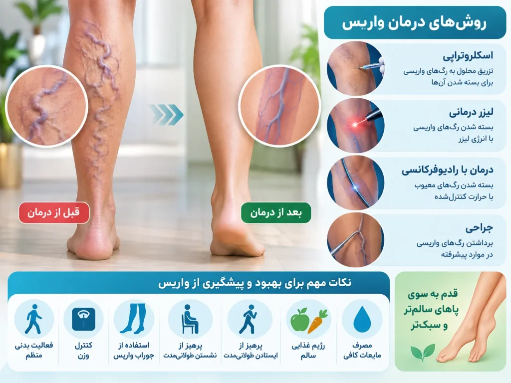 درمان واریس