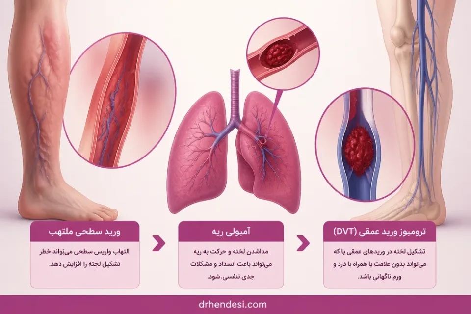 ترومبوز ورید عمقی و آمبولی ریه — مقایسه التهاب ورید سطحی با لخته خون در ورید عمقی پا